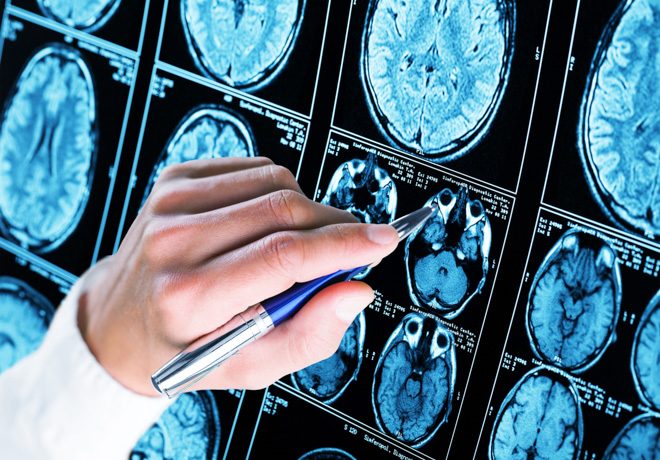Médico explicando en radiografías qué es la demencia frontotemporal. 