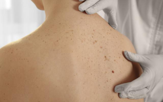 Persona con manchas marrones en la espalda